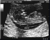 EQUIPO OBSTETRICO
Unidad Perinatal
Diagn�stico Pre-Natal
Tamizaje prenatal de defectos cong�nitos
TRANSLUCENCIA NORMAL
