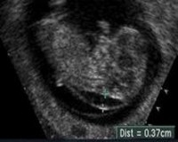 EQUIPO OBSTETRICO
Unidad Perinatal
Diagn�stico Pre-Natal
Tamizaje prenatal de defectos cong�nitos
TRANSLUCENCIA ANORMAL